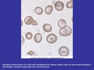 Peripheral blood smear of a child with hemoglobin SC disease. Sickle cells are seen less frequently in this disease, whereas target cells are more prominent.  