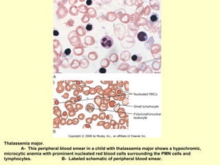 Thalassemia major.  A-  This peripheral blood smear in a child with thalassemia major shows a hypochromic, microcytic anemia with prominent nucleated red blood cells surrounding the PMN cells and lymphocytes.  B-  Labeled schematic of peripheral blood smear.  