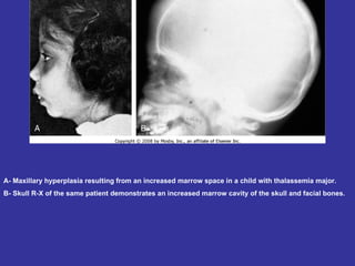 A- Maxillary hyperplasia resulting from an increased marrow space in a child with thalassemia major.  B- Skull R-X of the same patient demonstrates an increased marrow cavity of the skull and facial bones.  
