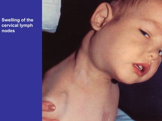 Swelling of the cervical lymph nodes 