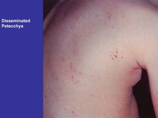 Disseminated Petecchya 