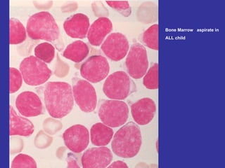 Bone Marrow  aspirate in  ALL child 