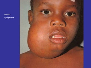 Burkitt Lymphoma 