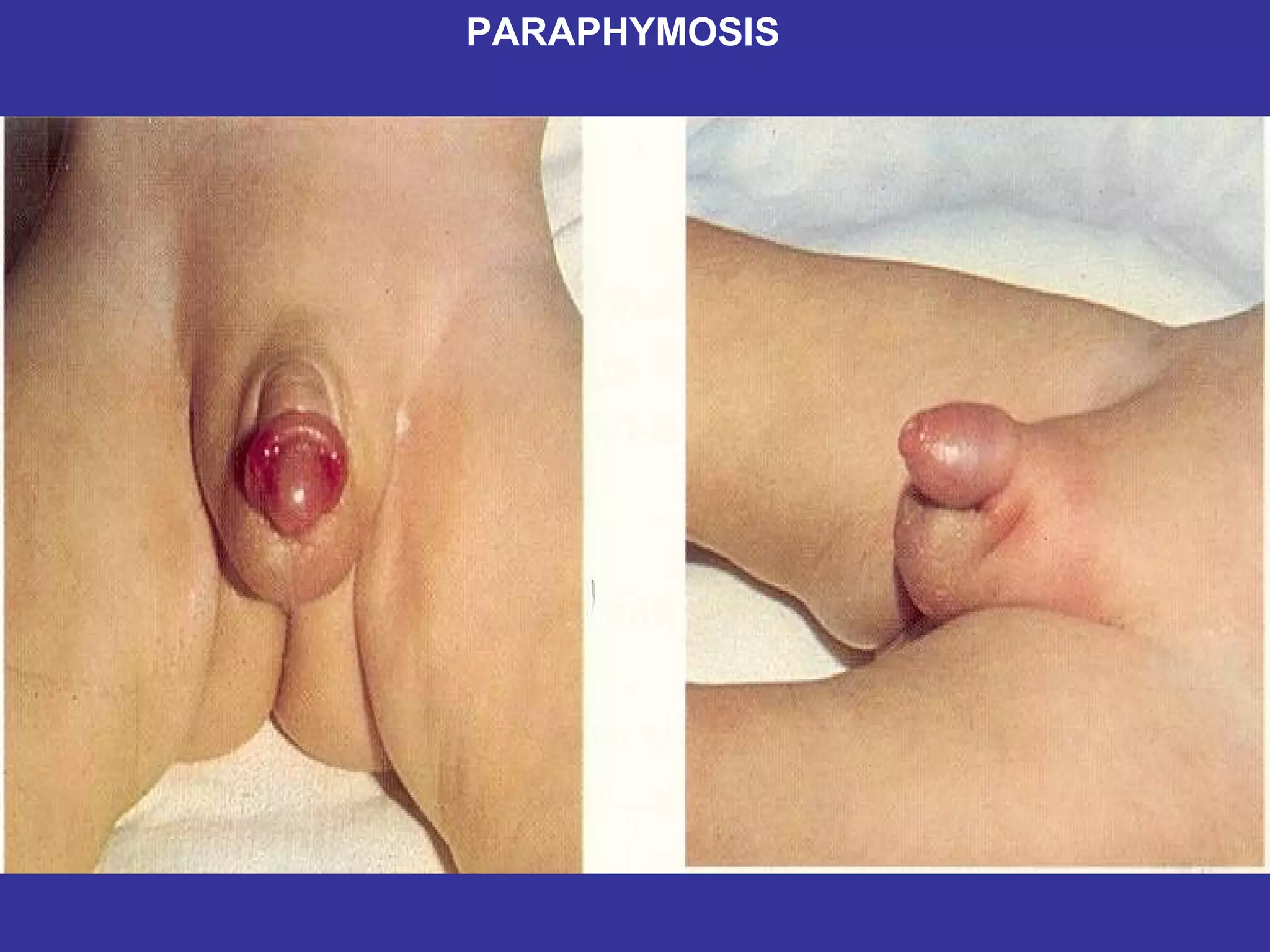 PARAPHYMOSIS 