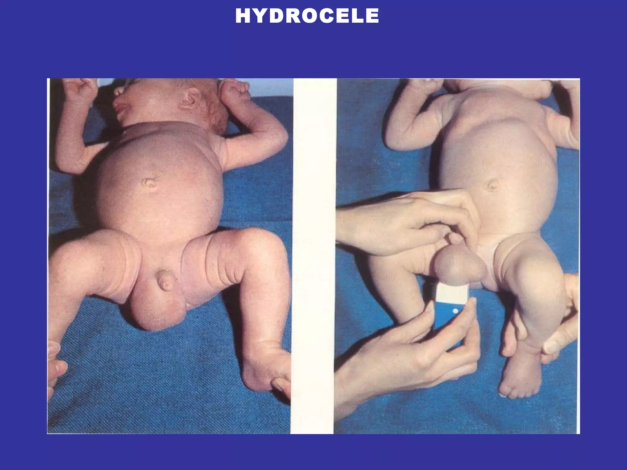 HYDROCELE 