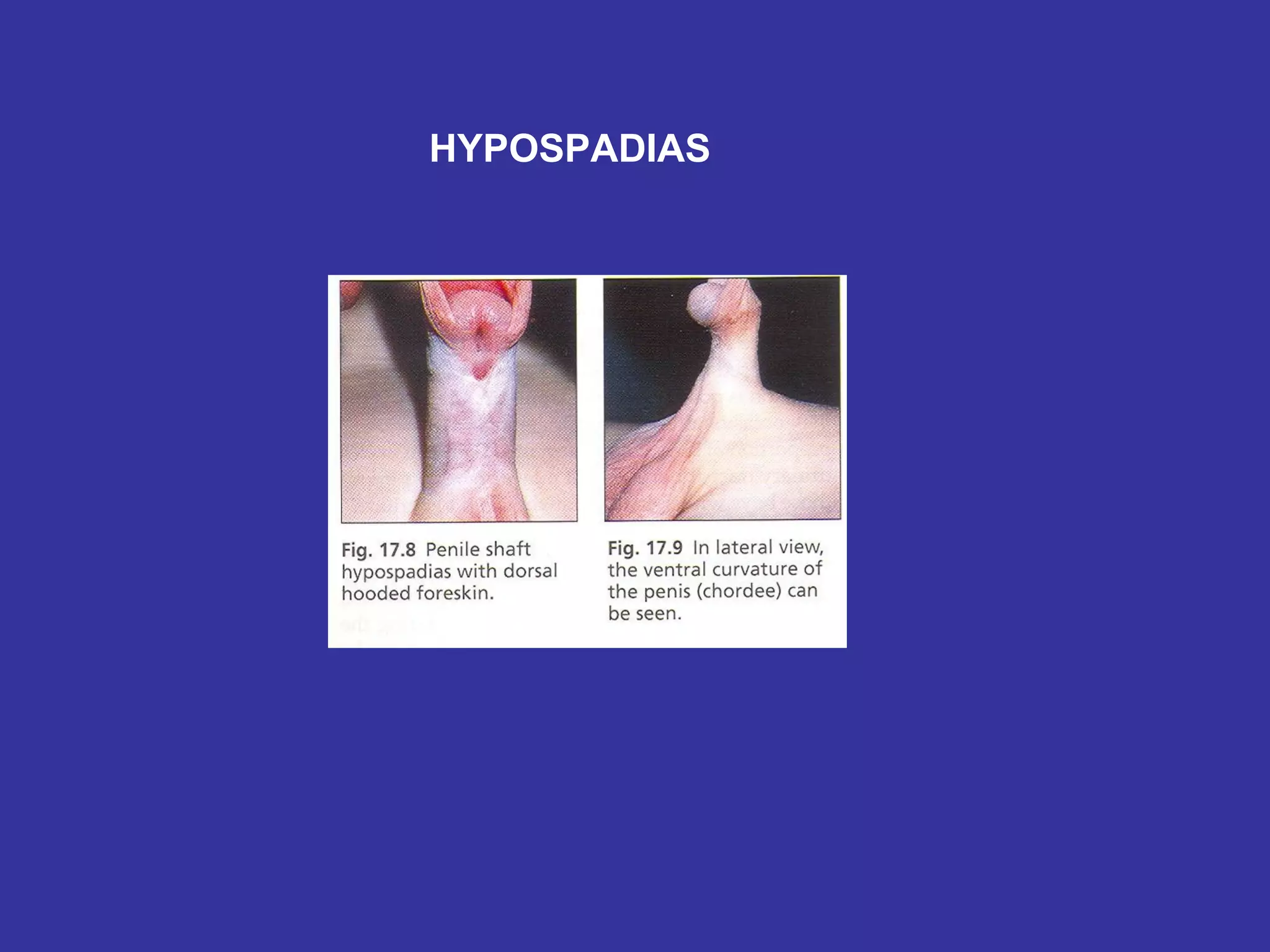 HYPOSPADIAS 
