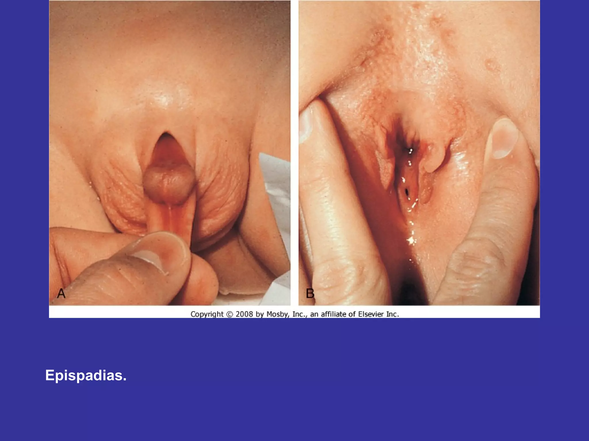 Epispadias.  