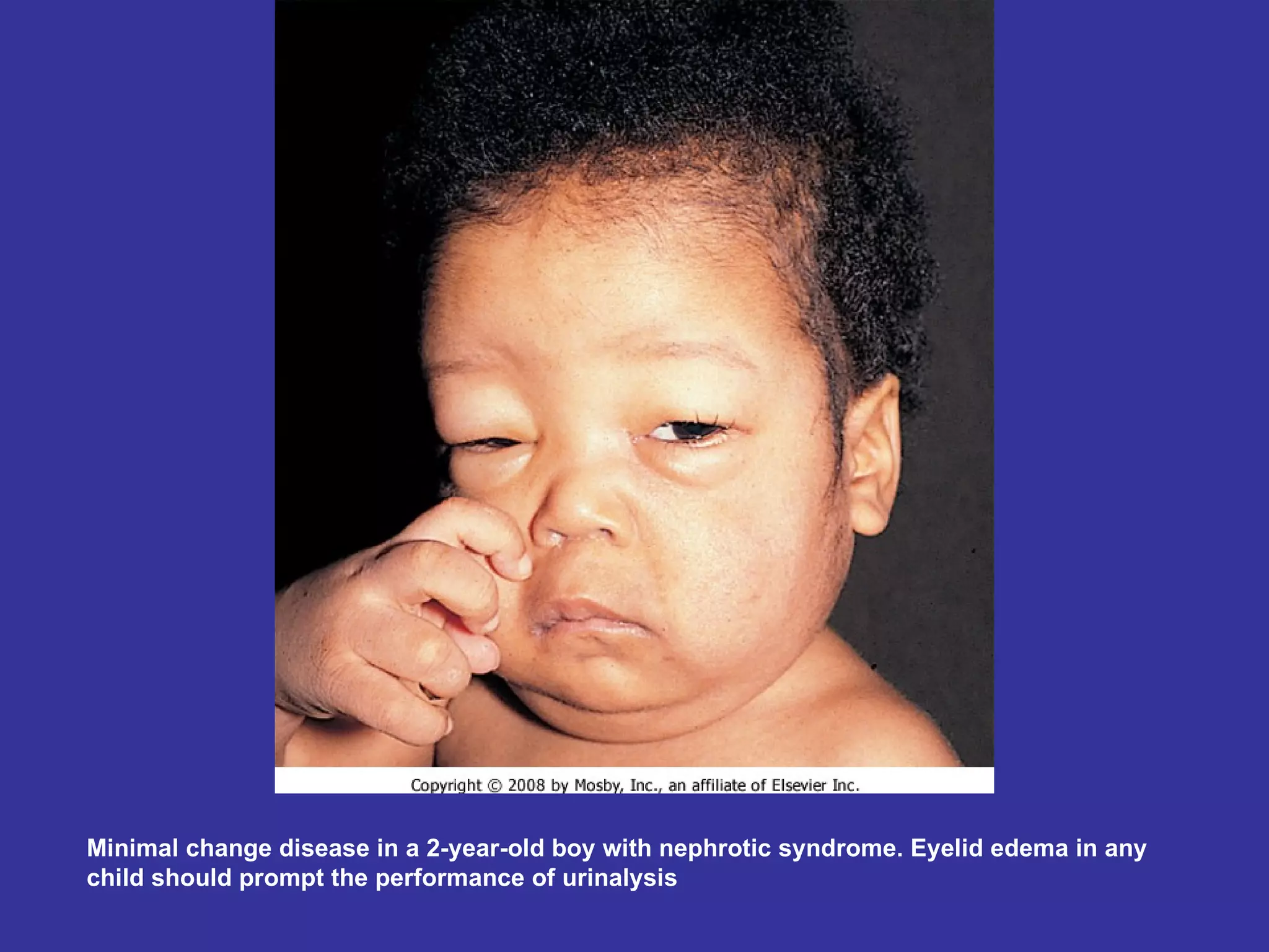 Minimal change disease in a 2-year-old boy with nephrotic syndrome. Eyelid edema in any child should prompt the performance of urinalysis  