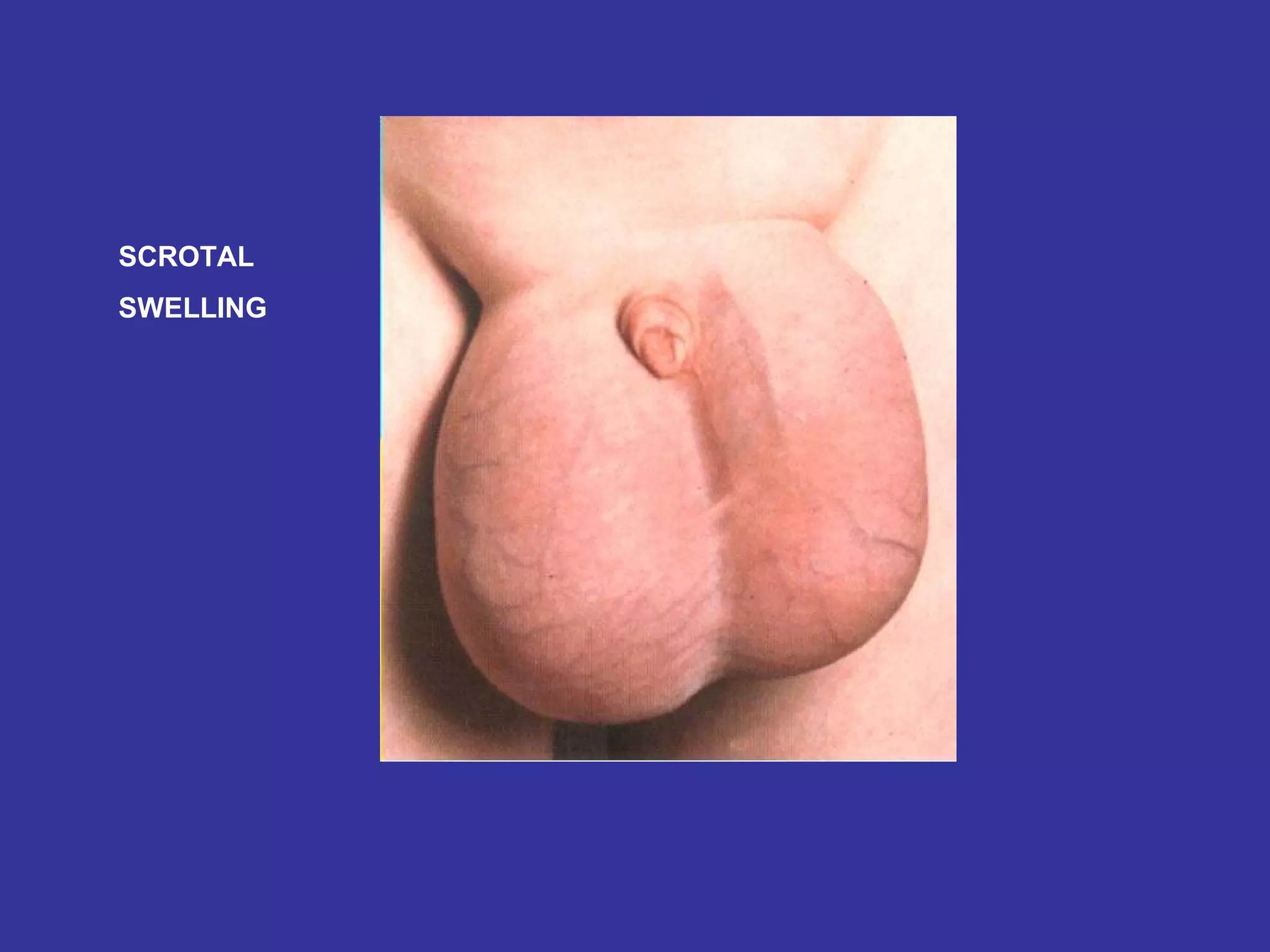 SCROTAL SWELLING 