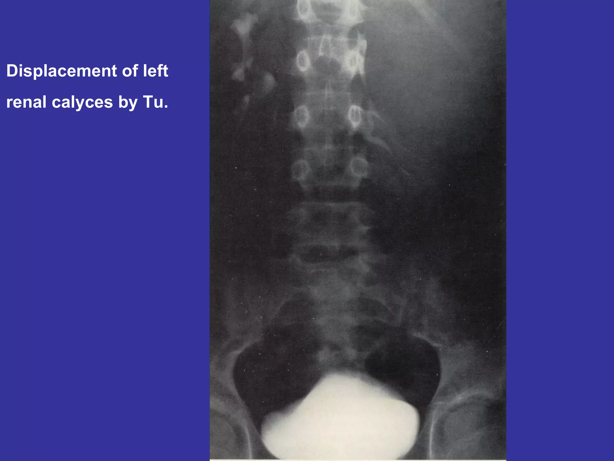 Displacement of left renal calyces by Tu. 