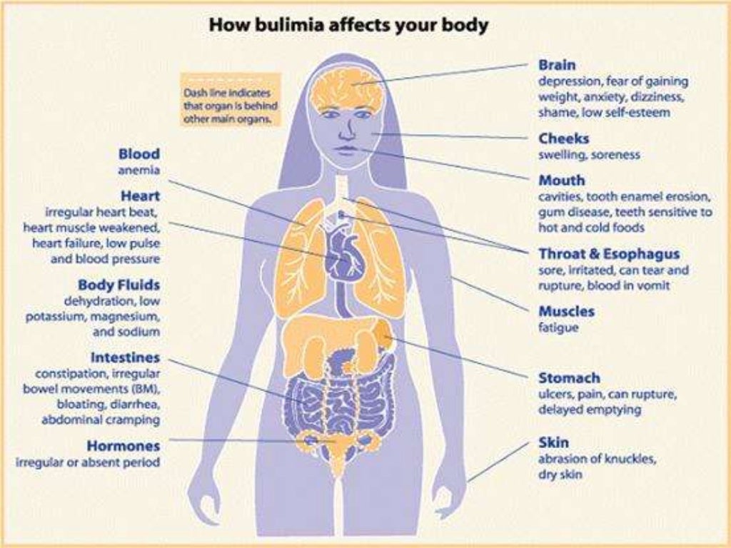 Bulimia Nervosa