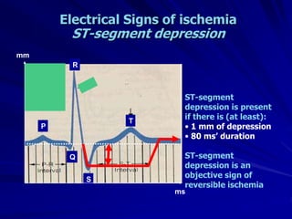 Electrical Signs of ischemia
ST-segment depression
P
Q
R
S
T
ST-segment
depression is present
if there is (at least):
• 1 mm of depression
• 80 ms’ duration
ST-segment
depression is an
objective sign of
reversible ischemia
mm
ms
 