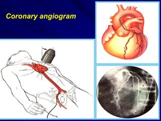 Coronary angiogram
 