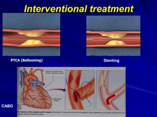 Interventional treatment
PTCA (Ballooning) Stenting
CABG
 