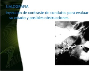 SIALOGRAFIAInyeccion de contraste de condutos para evaluar su estado y posibles obstrucciones.