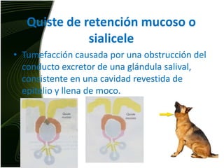 Quiste de retención mucoso o sialiceleTumefacción causada por una obstrucción del conducto excretor de una glándula salival, consistente en una cavidad revestida de epitelio y llena de moco.