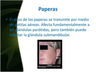 PaperasEI virus de las paperas se transmite por medio de gotitas aéreas. Afecta fundamentalmente a las glándulas parótidas, pero también puede infectar la glándula submandibular.