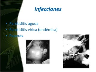 InfeccionesParotiditis agudaParotiditis vírica (endémica)Paperas