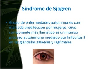 Síndrome de SjogrenGrupo de enfermedades autoinmunes con marcada predilección por mujeres, cuyo componente más llamativo es un intenso proceso autoinmune mediado por linfocitos T en las glándulas salivales y lagrimales.