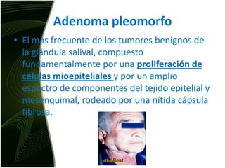 Adenoma pleomorfoEl mas frecuente de los tumores benignos de la glándula salival, compuesto fundamentalmente por una proliferación de células mioepitelialesy por un amplio espectro de componentes del tejido epitelial y mesenquimal, rodeado por una nítida cápsula fibrosa.