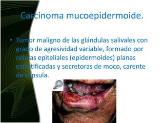 Carcinoma mucoepidermoide.Tumor maligno de las glándulas salivales con grado de agresividad variable, formado por células epiteliales (epidermoides) planas estratificadas y secretoras de moco, carente de cápsula. 