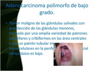 Adenocarcinoma polimorfo de bajo grado.Tumor maligno de las glándulas salivales con predilección de las glándulas menores, formado por una amplia variedad de patrones lobulillares y cribiformes en las área centrales y por un patrón tubular en capas monocelulares en la periferia, y cuyo potencial metastásico es bajo.