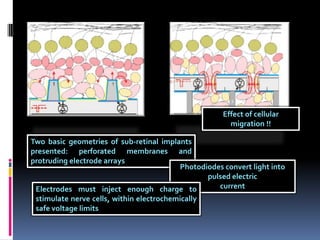 A videocameratransmits640 × 480 pixel images at 25–50 Hz to a pocket PC.The computer processes the data and displays the resulting video on an LCD matrix mounted on goggles worn by the patientThe LCD screen is illuminated with pulsed near-infrared (NIR, 800–900 nm) light, projecting each video image through the eye optics onto the retinaThe NIR light is then received by a  photodiode array on a ∼3 mm implanted chip