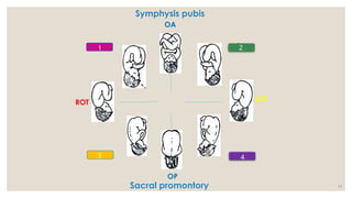 17
Symphysis pubis
Sacral promontory
OA
LOT
ROT
OP
LOA
ROA
LOP
ROP
1 2
3 4
 