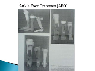 Ankle Foot Orthoses (AFO)
 