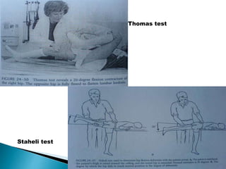 Thomas test
Staheli test
 
