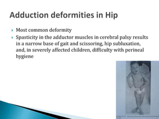  Most common deformity
 Spasticity in the adductor muscles in cerebral palsy results
in a narrow base of gait and scisso...