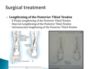  Split Tendon
Transfers
◦ Split posterior tibial
tendon transfer
It is one of the most common
procedures for equinovarus
...