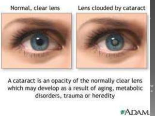  Cataract
 A cataract is a clouding of the lens in your eye. It affects your vision. Cataracts are very
common in older people. By age 80, more than half of all people in the United States
either have a cataract or have had cataract surgery.
 Common symptoms are
 Blurry vision
 Colors that seem faded
 Glare
 Not being able to see well at night
 Double vision
 Frequent prescription changes in your eye wear
 Cataracts usually develop slowly. New glasses, brighter lighting, anti-glare sunglasses
or magnifying lenses can help at first. Surgery is also an option. It involves removing the
cloudy lens and replacing it with an artificial lens. Wearing sunglasses and a hat with a
brim to block ultraviolet sunlight may help to delay cataracts.
 