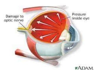  Glaucoma
 Glaucoma damages the eye's optic
nerve. It usually happens when the fluid
pressure inside the eyes slowly rises,
damaging the optic nerve. Often there
are no symptoms at first, but a
comprehensive eye exam can detect it.
 People at risk should get eye exams at
least every two years.
 Early treatment can help protect your
eyes against vision loss. Treatments usually
include prescription eyedrops and/or
surgery.
 