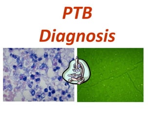 PTB
Diagnosis
 