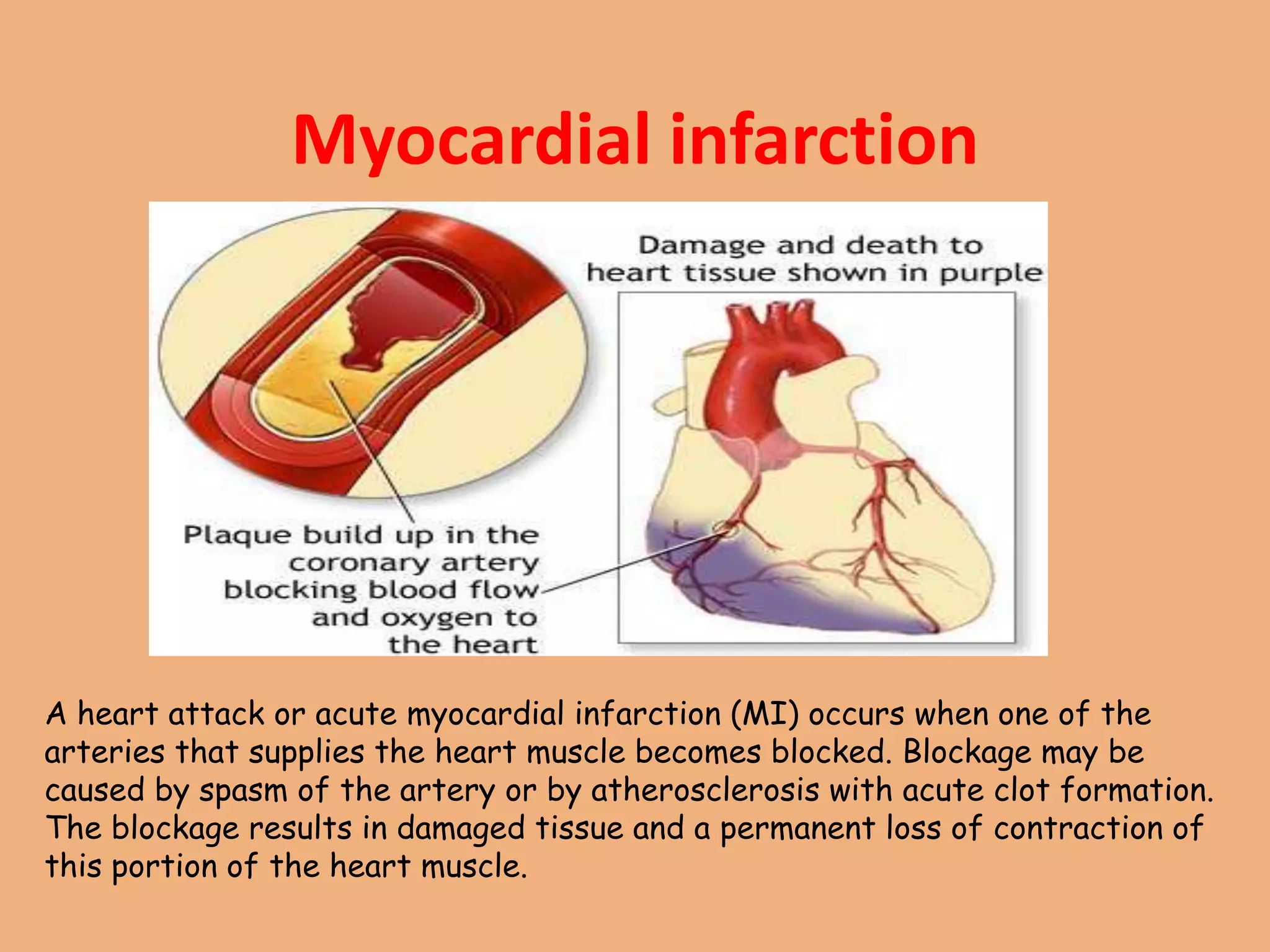 Myocardial infarction
A heart attack or acute myocardial infarction (MI) occurs when one of the
arteries that supplies the heart muscle becomes blocked. Blockage may be
caused by spasm of the artery or by atherosclerosis with acute clot formation.
The blockage results in damaged tissue and a permanent loss of contraction of
this portion of the heart muscle.
 