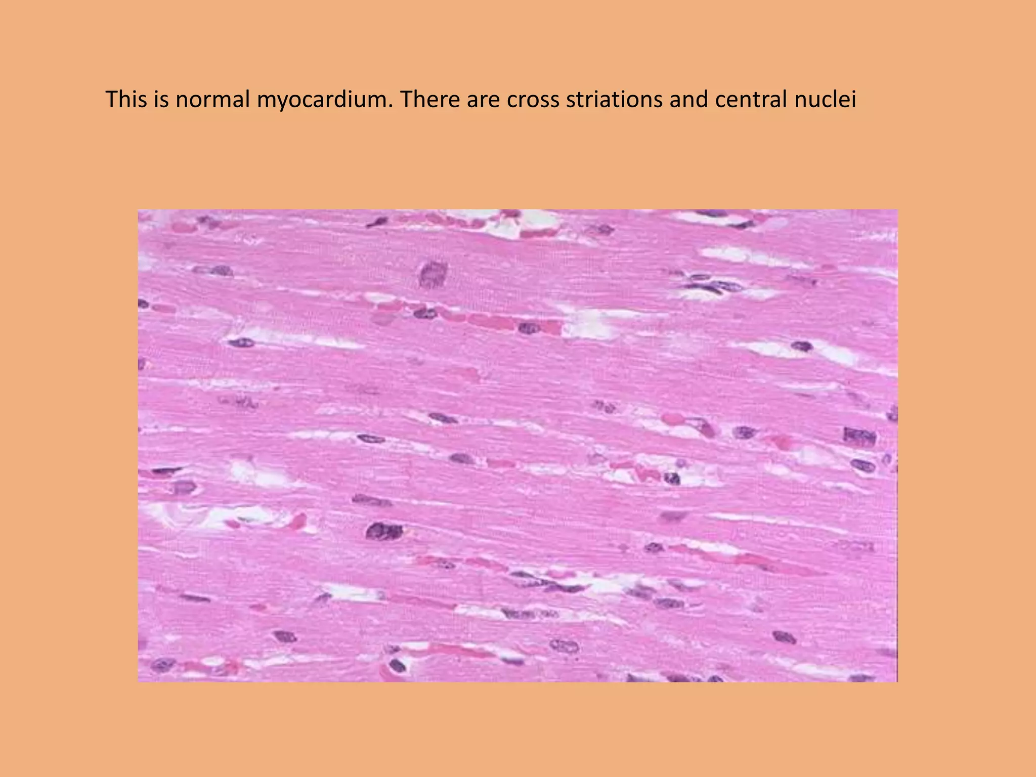 This is normal myocardium. There are cross striations and central nuclei
 
