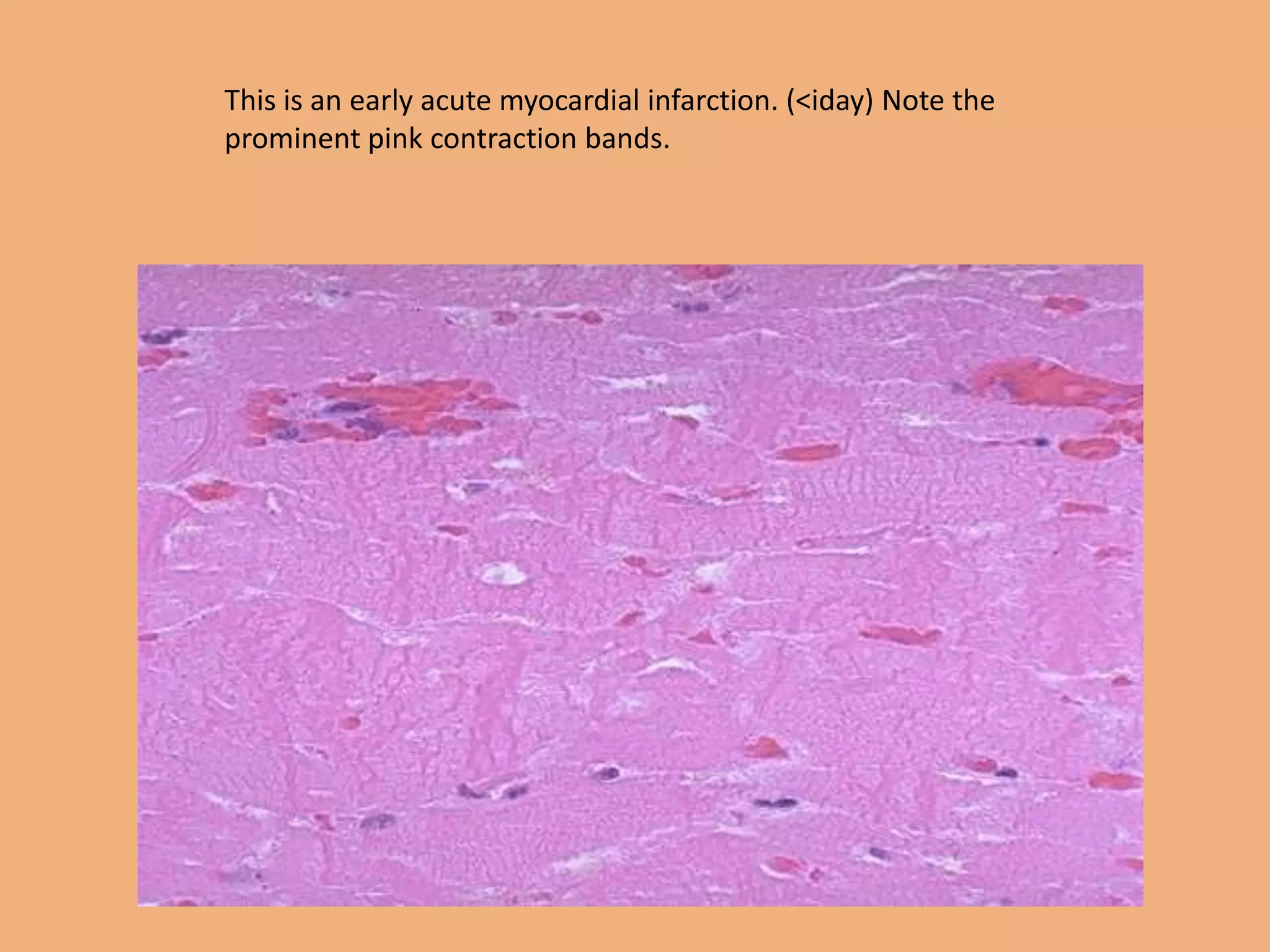 This is an early acute myocardial infarction. (<iday) Note the
prominent pink contraction bands.
 