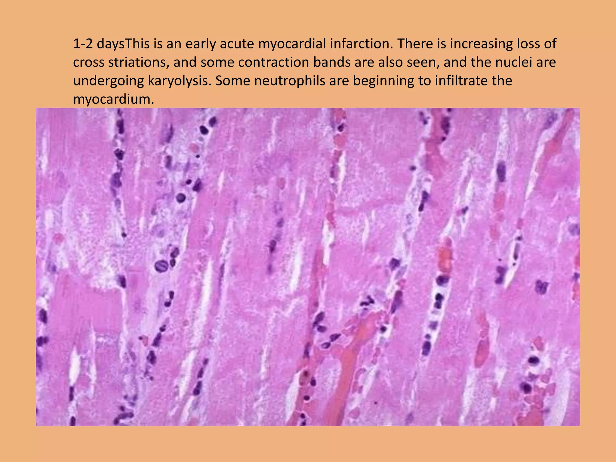 1-2 daysThis is an early acute myocardial infarction. There is increasing loss of
cross striations, and some contraction bands are also seen, and the nuclei are
undergoing karyolysis. Some neutrophils are beginning to infiltrate the
myocardium.
 