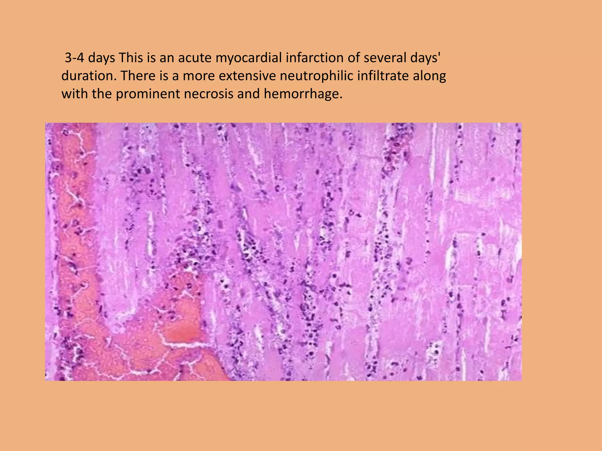 3-4 days This is an acute myocardial infarction of several days'
duration. There is a more extensive neutrophilic infiltrate along
with the prominent necrosis and hemorrhage.
 