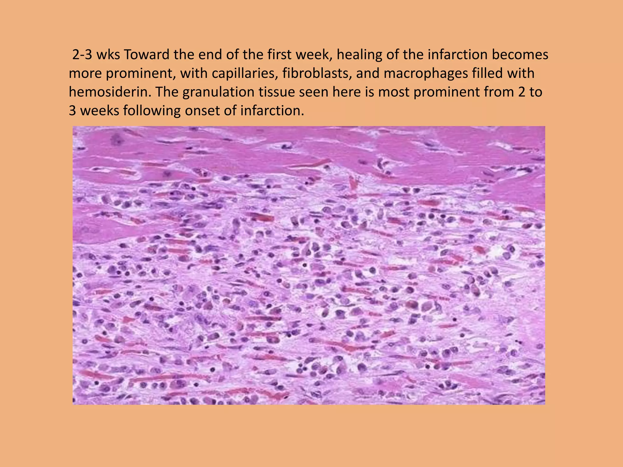 2-3 wks Toward the end of the first week, healing of the infarction becomes
more prominent, with capillaries, fibroblasts, and macrophages filled with
hemosiderin. The granulation tissue seen here is most prominent from 2 to
3 weeks following onset of infarction.
 