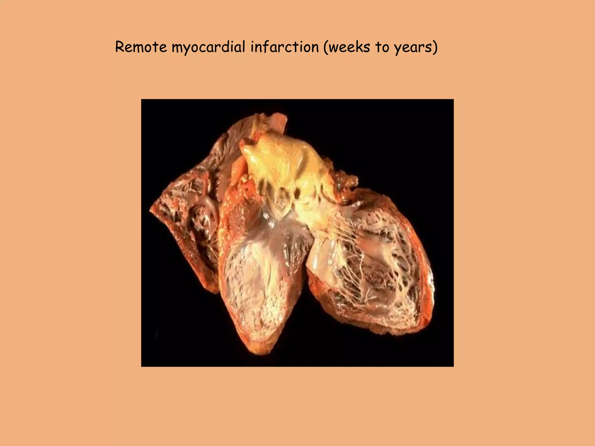 Remote myocardial infarction (weeks to years)
 