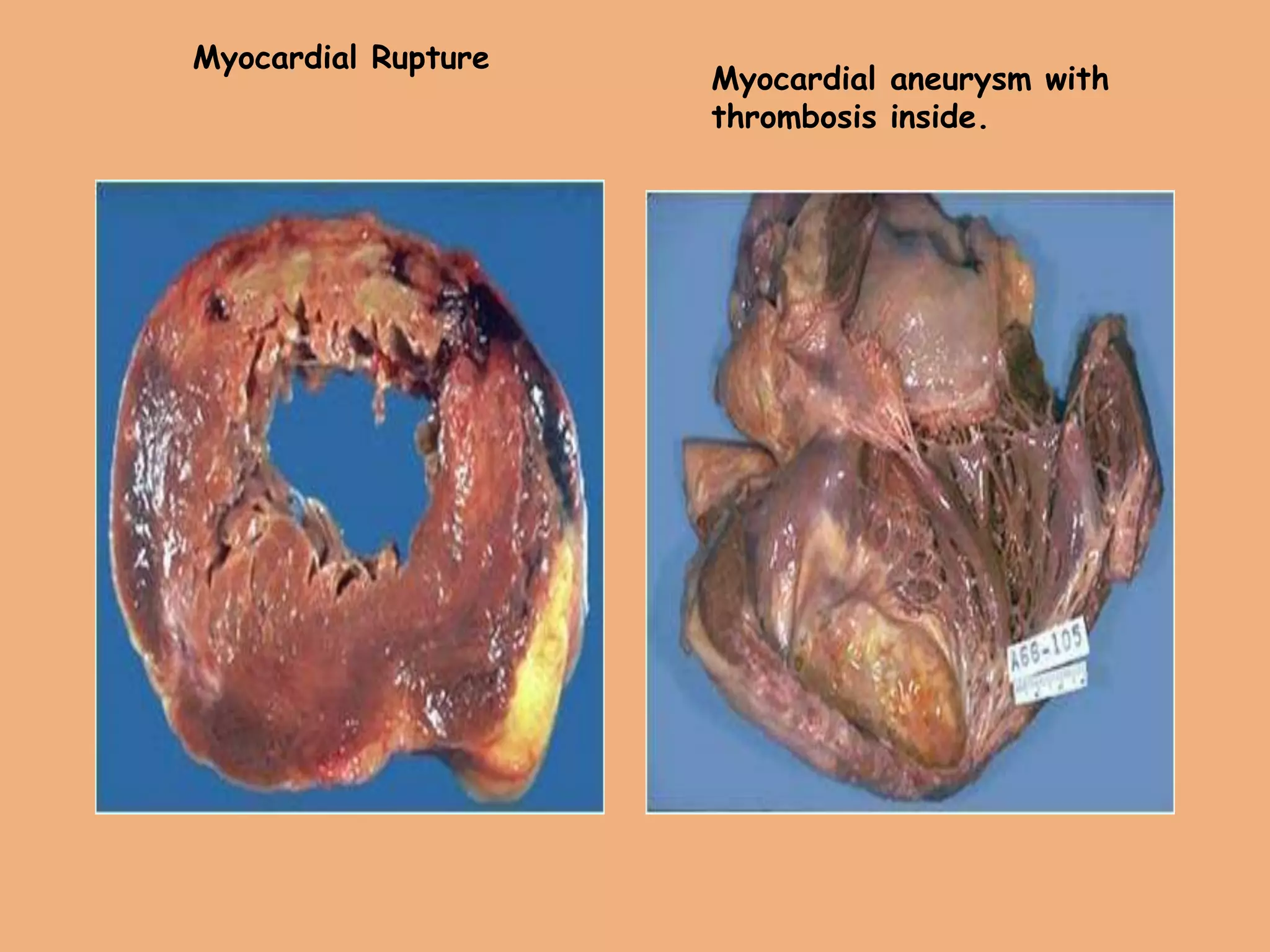 Myocardial Rupture
Myocardial aneurysm with
thrombosis inside.
 