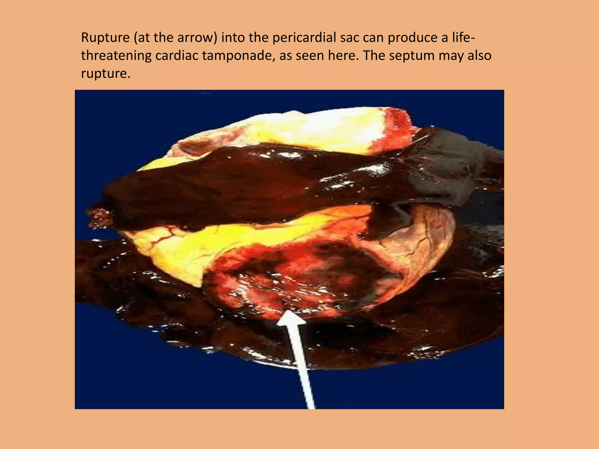 Rupture (at the arrow) into the pericardial sac can produce a life-
threatening cardiac tamponade, as seen here. The septum may also
rupture.
 