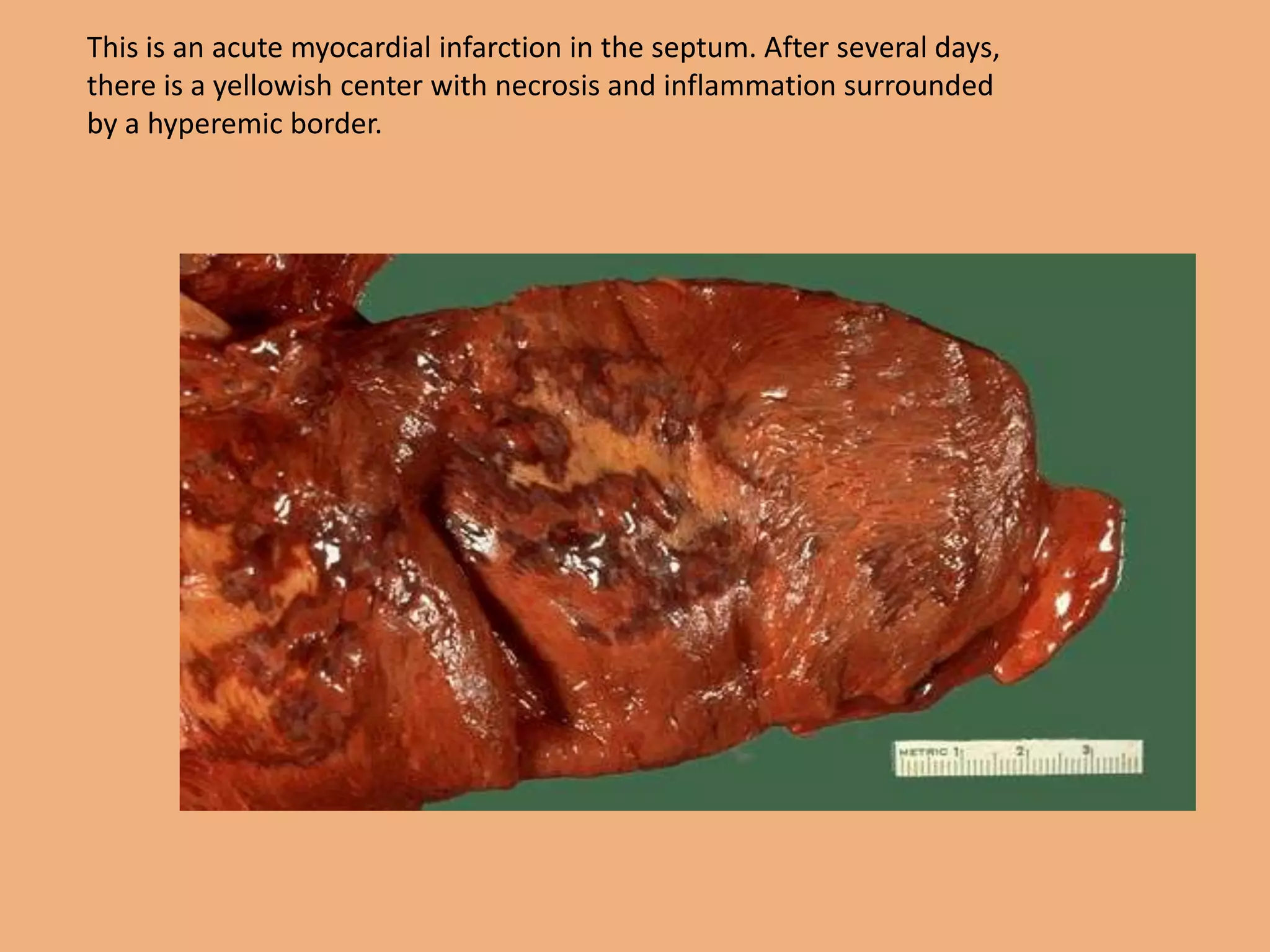 This is an acute myocardial infarction in the septum. After several days,
there is a yellowish center with necrosis and inflammation surrounded
by a hyperemic border.
 