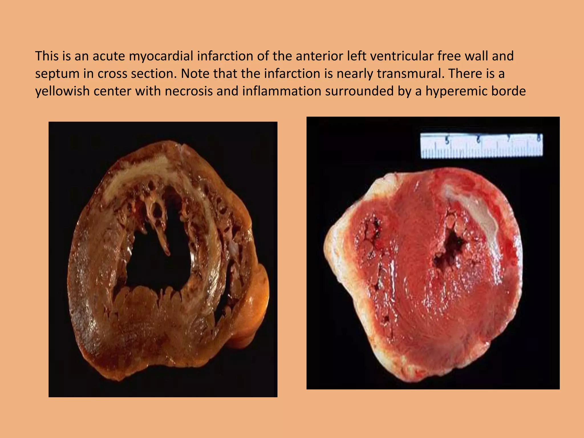 This is an acute myocardial infarction of the anterior left ventricular free wall and
septum in cross section. Note that the infarction is nearly transmural. There is a
yellowish center with necrosis and inflammation surrounded by a hyperemic borde
 