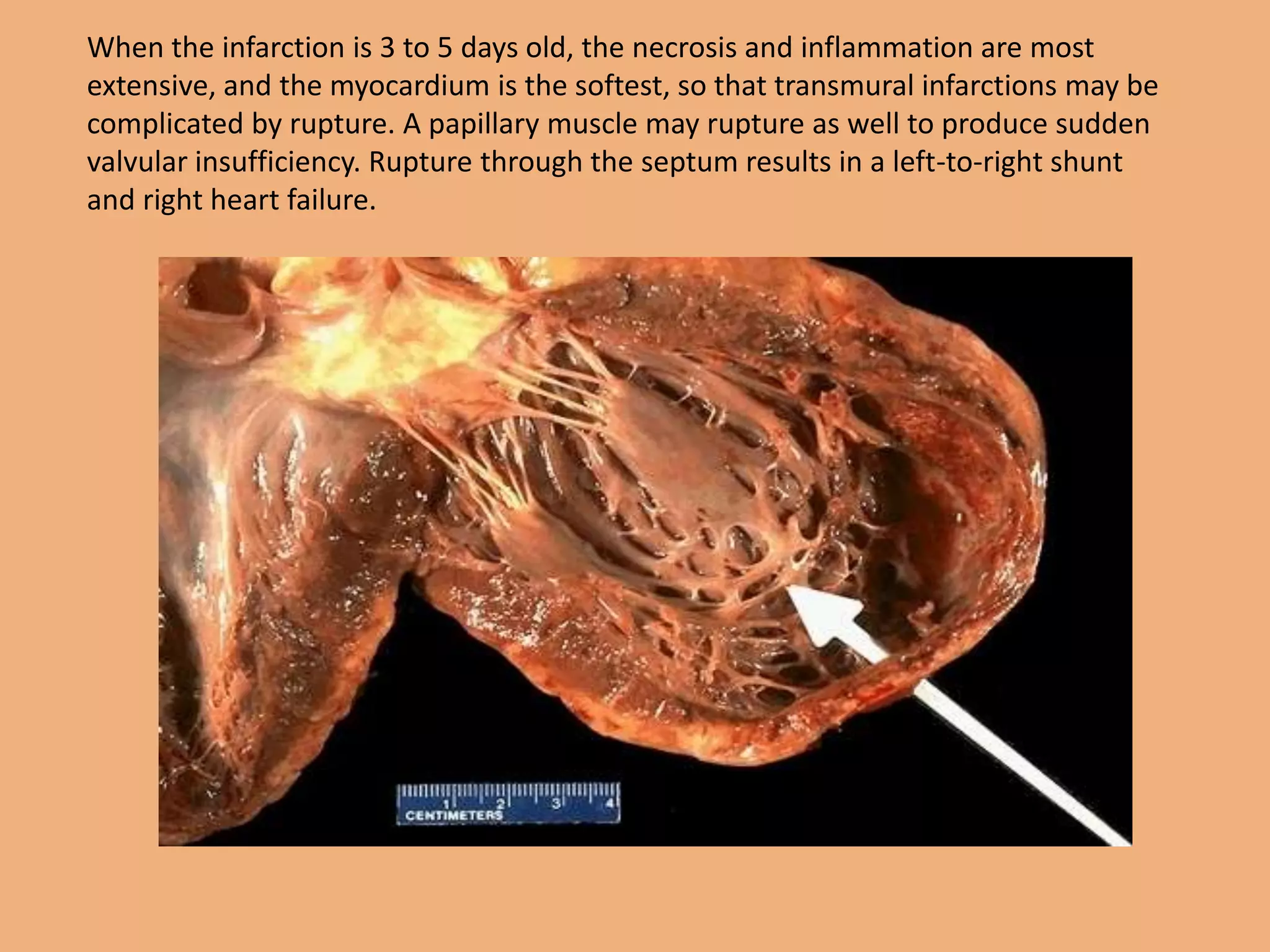 When the infarction is 3 to 5 days old, the necrosis and inflammation are most
extensive, and the myocardium is the softest, so that transmural infarctions may be
complicated by rupture. A papillary muscle may rupture as well to produce sudden
valvular insufficiency. Rupture through the septum results in a left-to-right shunt
and right heart failure.
 