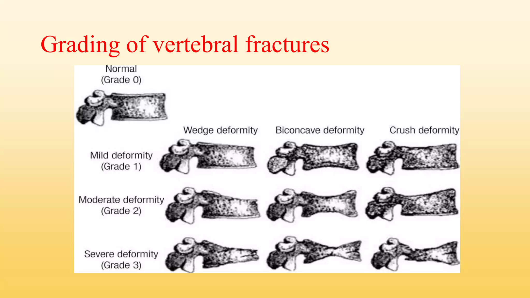 Diagnosis of osteoporosis ppt