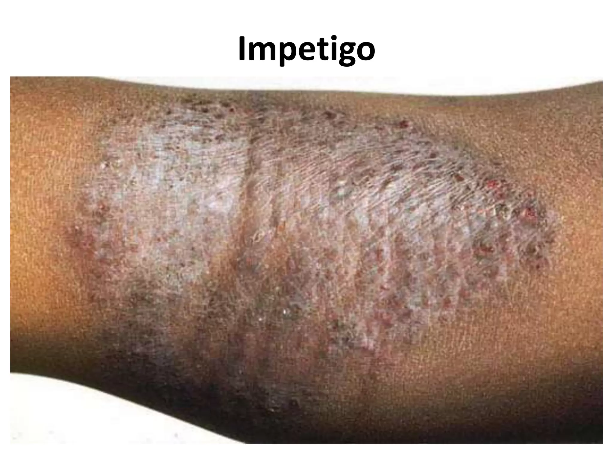 Impetigo
 