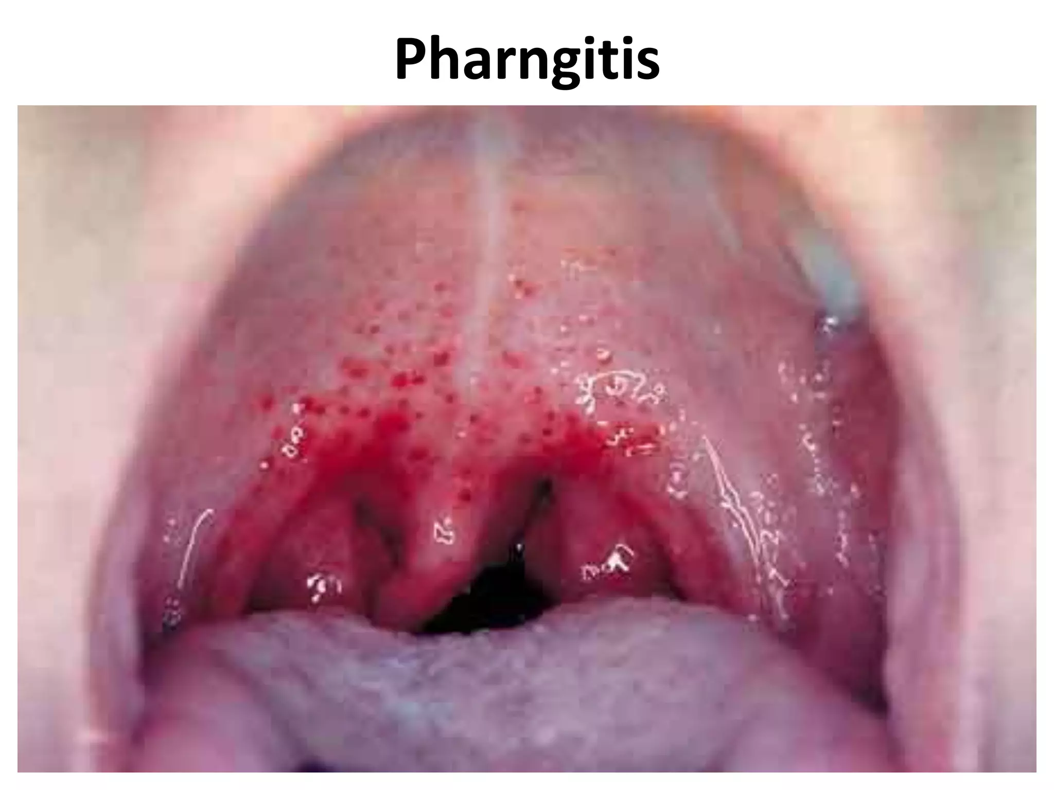 Pharngitis
 